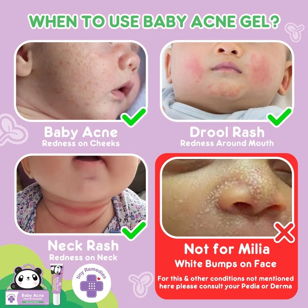Tiny Buds Baby Acne Soothing Gel 20g