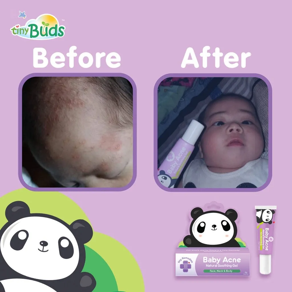 Tiny Buds Baby Acne Soothing Gel 20g